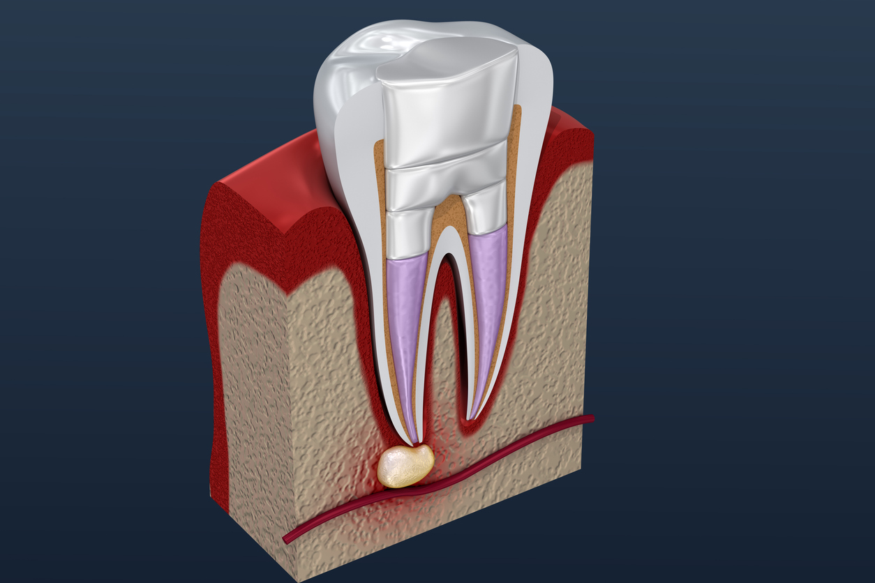 The imagw is a 3D illustration related to root canals showing the benefits of root canal therapy.