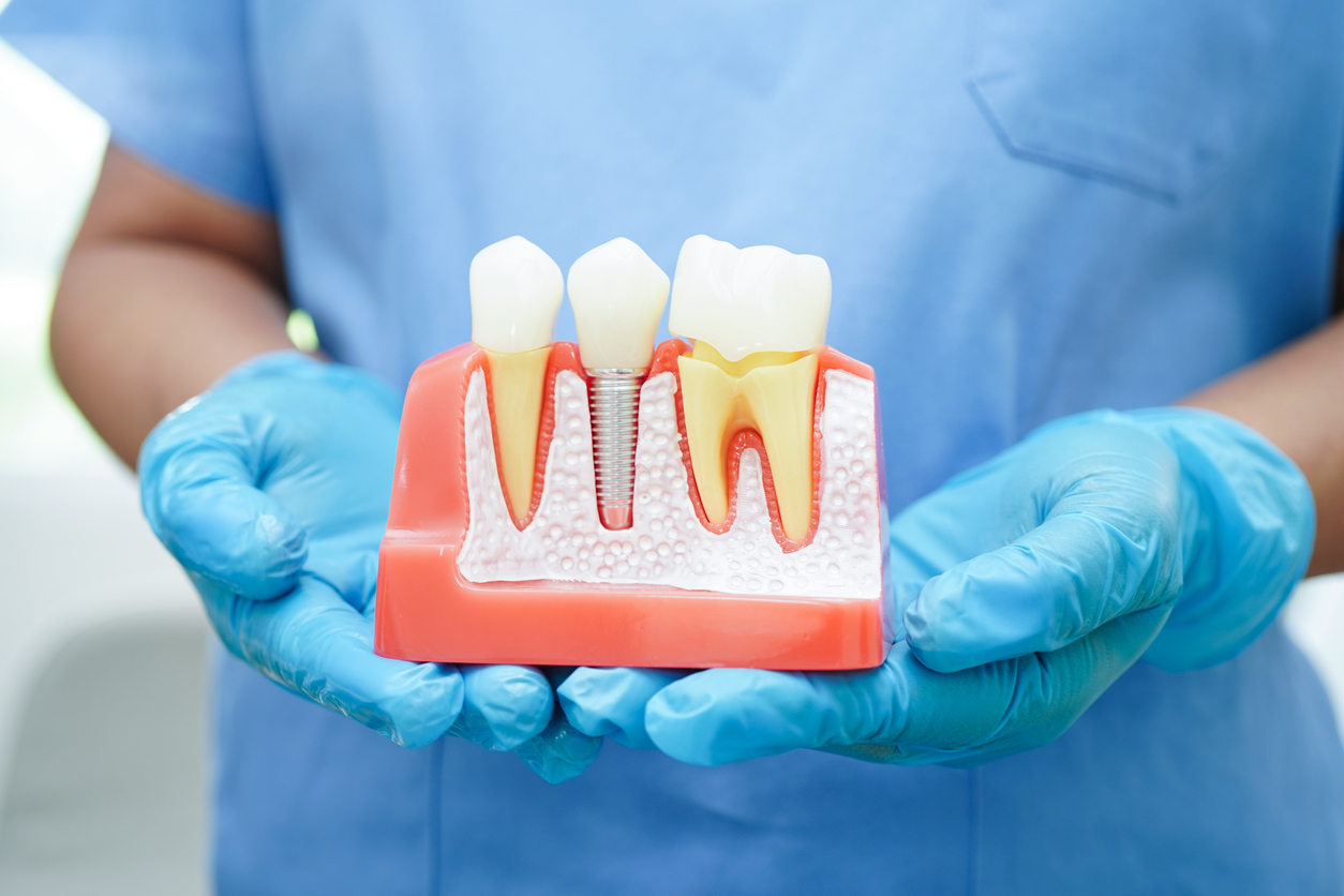 Featured image for The Different Types of Dental Implants